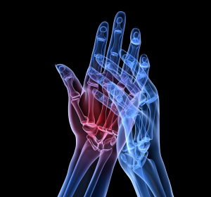 Psoriasis-Arthritis und rheumatoide Arthritis: Zeitgemäßes Therapiemanagement 